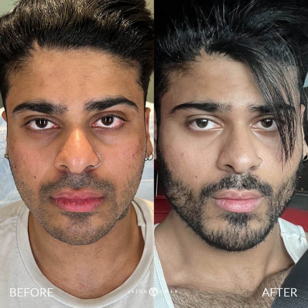 Male Facial Sculpting — before and after