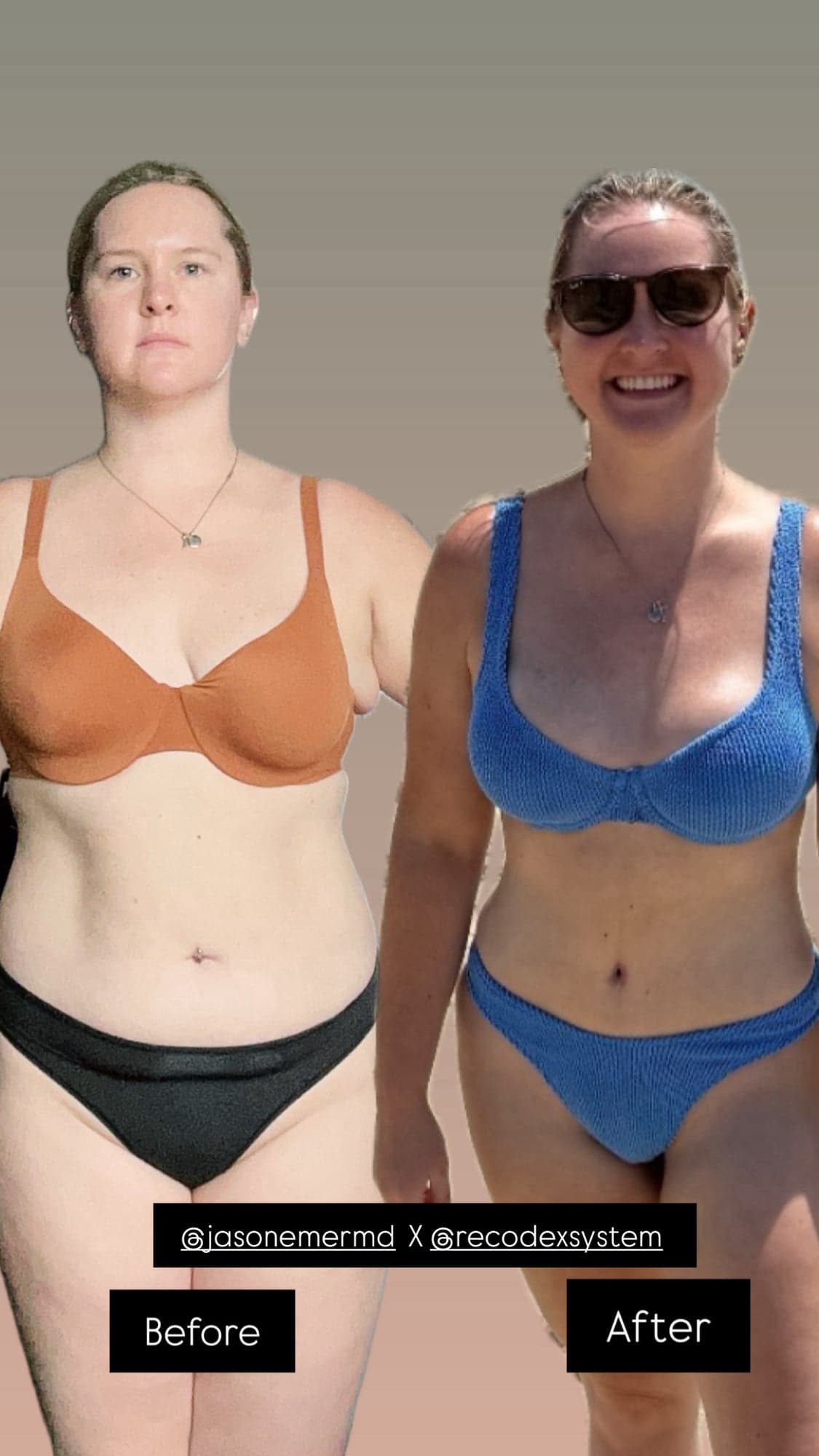 Supermodel Lipo Transformation — before and after