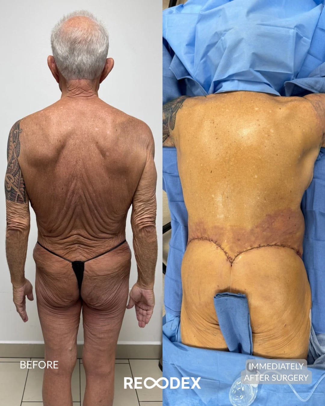 MAXORIS Body Sculpting Before and After