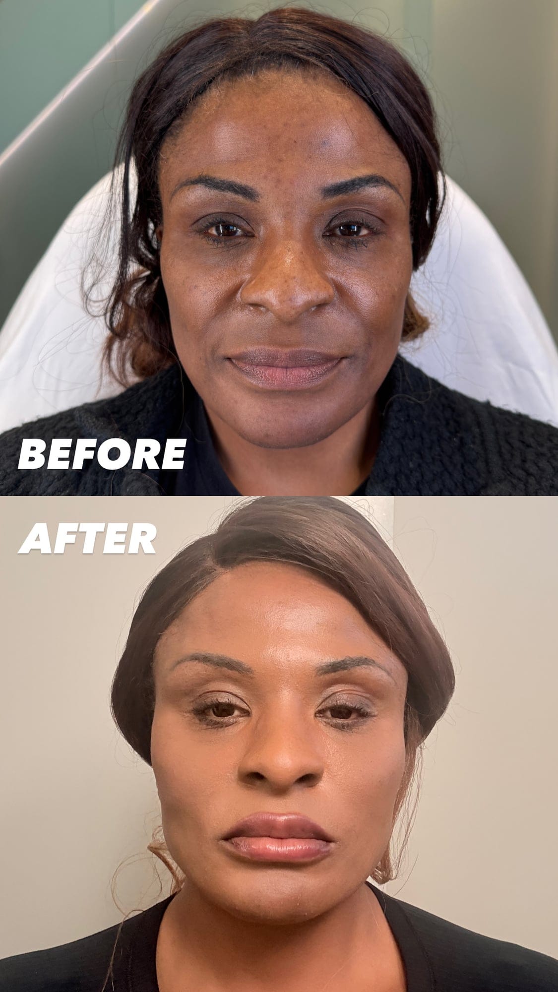 Female Facial Sculpting Before and After