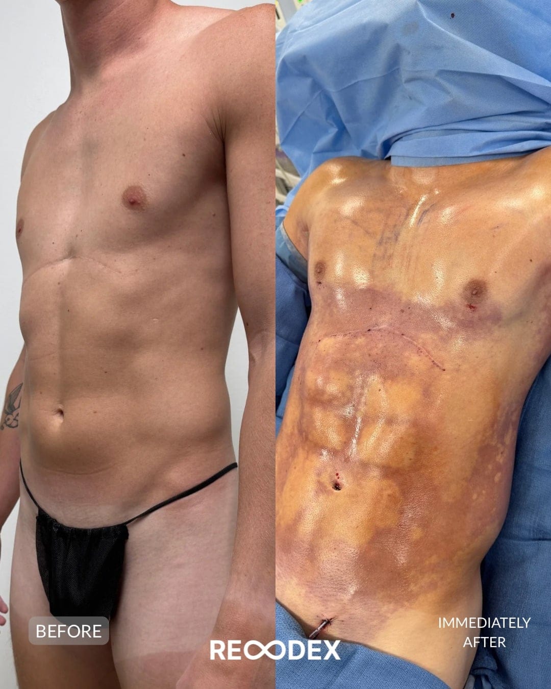 HD Body Sculpting & Implants Before and After