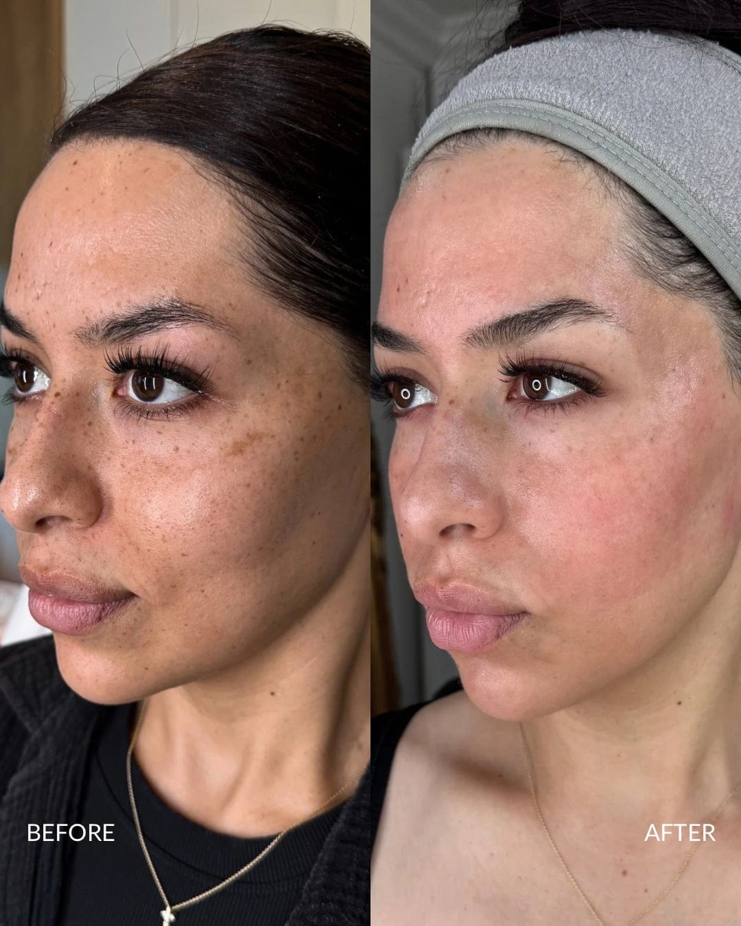 Acne Scar Reconstruction Before and After