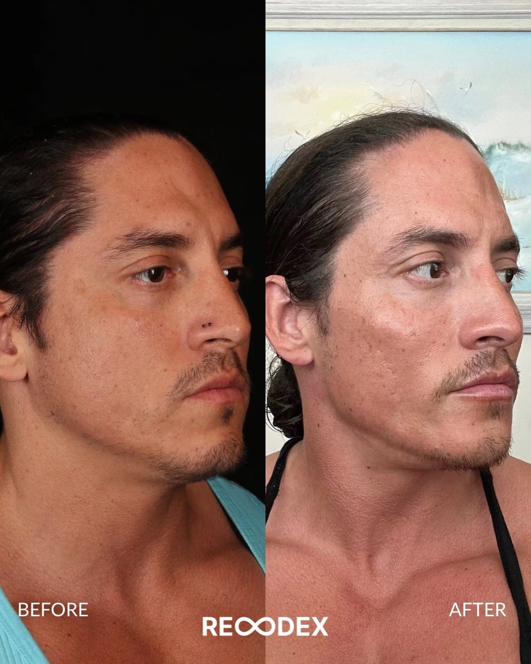 Male Facial Sculpting Before and After
