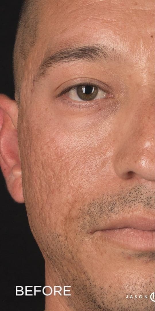 RE:SKN Acne Scars Treatment — Before